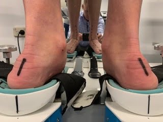 Uncorrected foot alignment