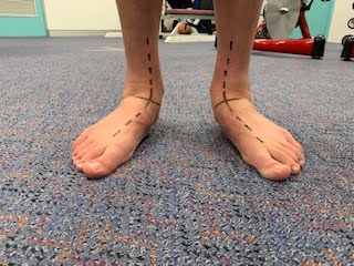 Patient standing showing the alignment lines on the feet
